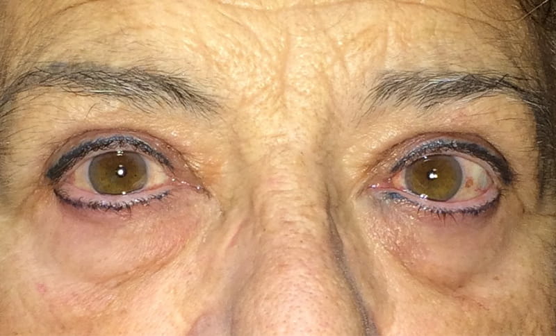 bilateral-upper-eyelid-blepharoplasty-after