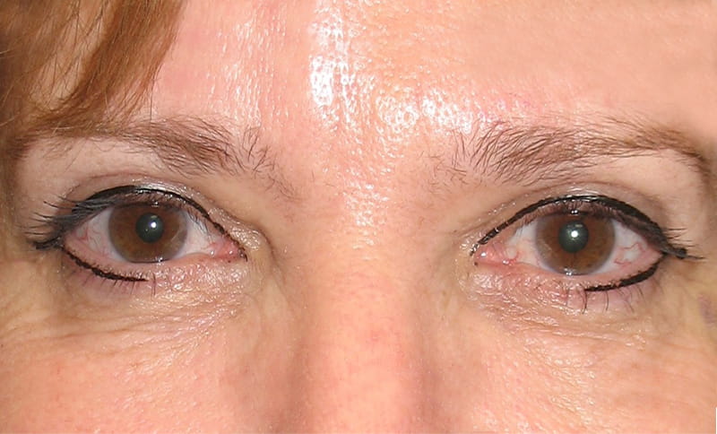 bilateral-upper-eyelid-blepharoplasty-after