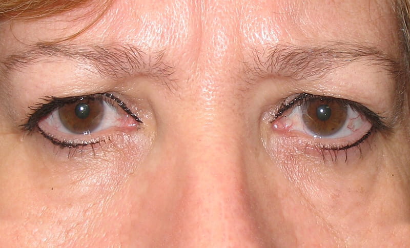 bilateral-upper-eyelid-blepharoplasty-before