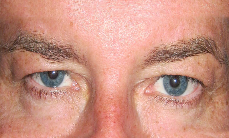 bilateral-upper-eyelid-blepharoplasty-before