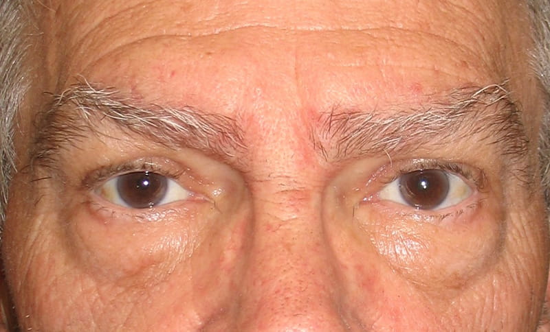 bilateral-upper-eyelid-blepharoplasty-bilateral-drooping-eyelid-ptosis-correction-after