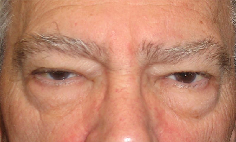 bilateral-upper-eyelid-blepharoplasty-bilateral-drooping-eyelid-ptosis-correction-before