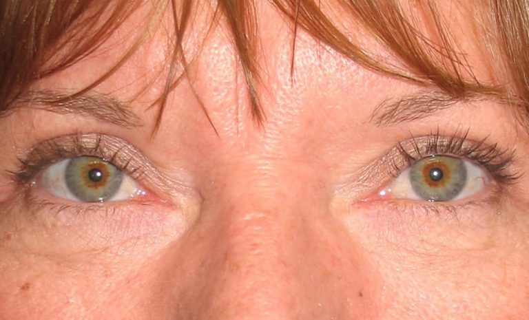 Bilateral Upper Eyelid Blepharoplasty Bilateral Drooping Eyelid Ptosis