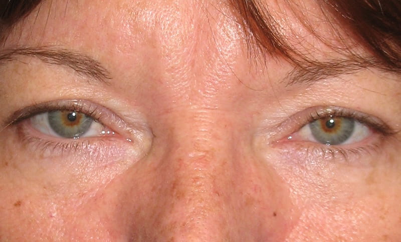 bilateral-upper-eyelid-blepharoplasty-bilateral-drooping-eyelid-ptosis-repair-before