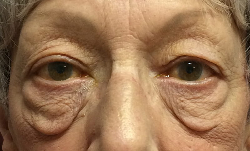 bilateral-upper-eyelid-blepharoplasty-bilateral-removal-of-lower-eyelid-skin-bags-festoons-before
