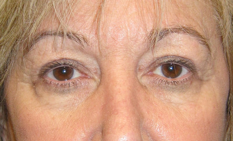 bilateral-upper-eyelid-blepharoplasty-correction-of-bilateral-drooping-upper-eyelids-ptosis-after