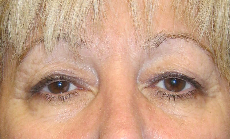 bilateral-upper-eyelid-blepharoplasty-correction-of-bilateral-drooping-upper-eyelids-ptosis-before