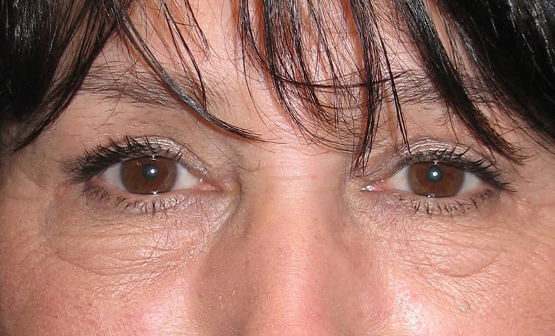 bilateral-upper-eyelid-blepharoplasty-removal-of-lower-eyelid-bags-after