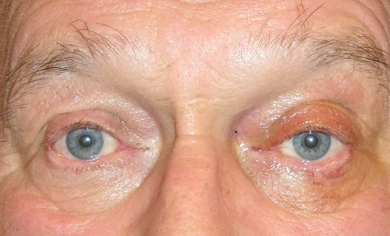 correction-of-bilateral-drooping-upper-eyelids-ptosis-after