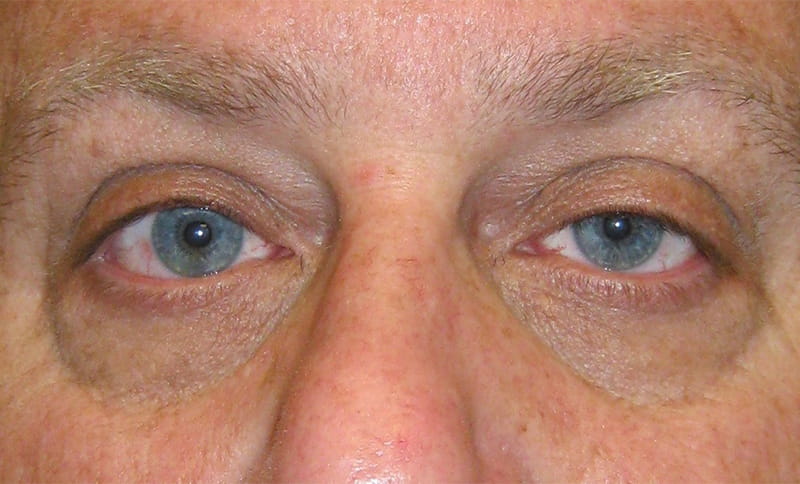 correction-of-bilateral-drooping-upper-eyelids-ptosis-before