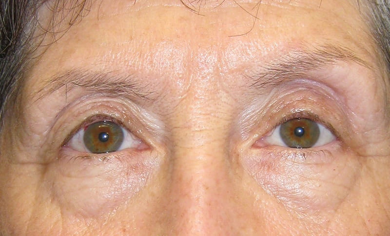 correction-of-drooping-upper-eyelids-ptosis-after