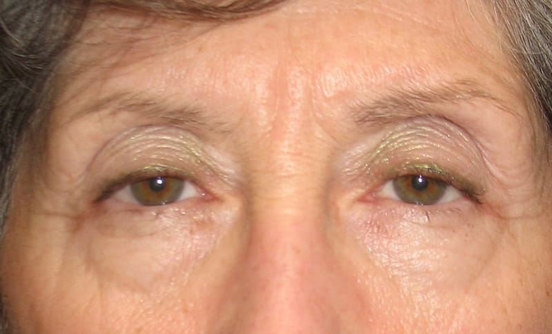 correction-of-drooping-upper-eyelids-ptosis-before