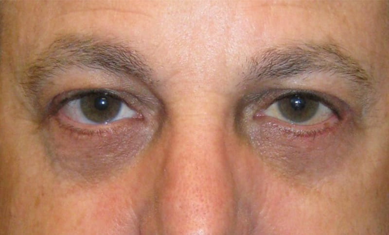 removal-of-bilateral-lower-eyelid-bags-after
