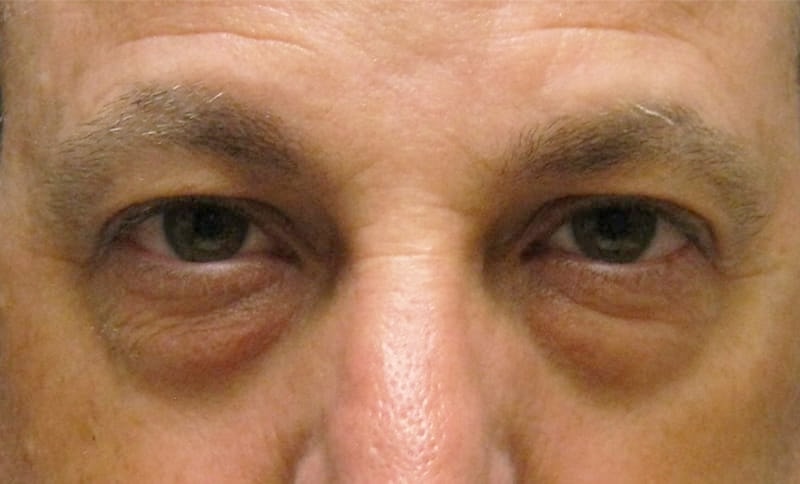 removal-of-bilateral-lower-eyelid-bags-before