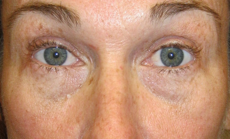 removal-of-lower-eyelid-bags-after