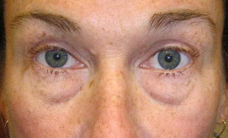 removal-of-lower-eyelid-bags-before