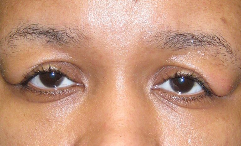 Repositioning Of Bilateral Prolapsed Lacrimal Glands Before Nissman Eye